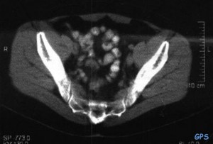 Computertomographie Becken mit Kontrastmittel