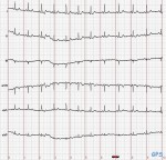 Elektrokardiogramm (EKG)