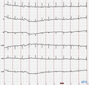 Elektrokardiogramm (EKG)