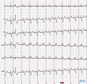 Schrittmacher-EKG