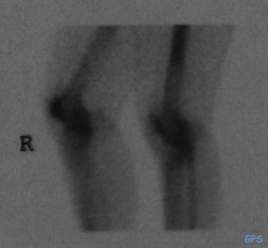 Szintigraphie der Knie