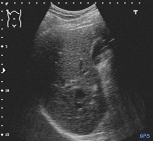 Ultraschall der Leber